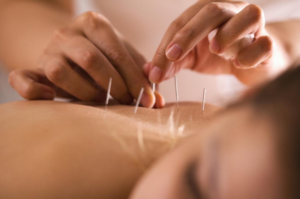 The Benefits of Acupuncture